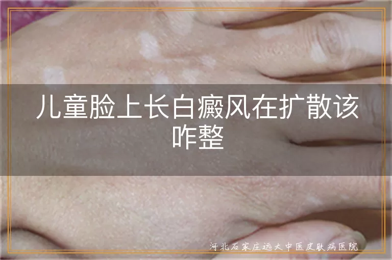 儿童脸上长白癜风在扩散该咋整