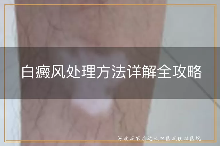 白癜风处理方法详解全攻略
