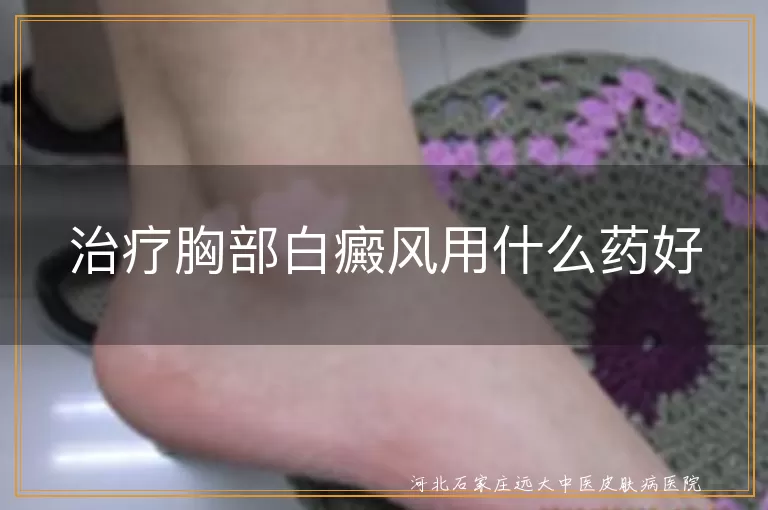 治疗胸部白癜风用什么药好