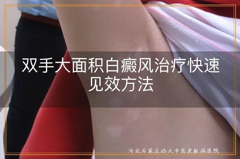 双手大面积白癜风治疗快速见效方法