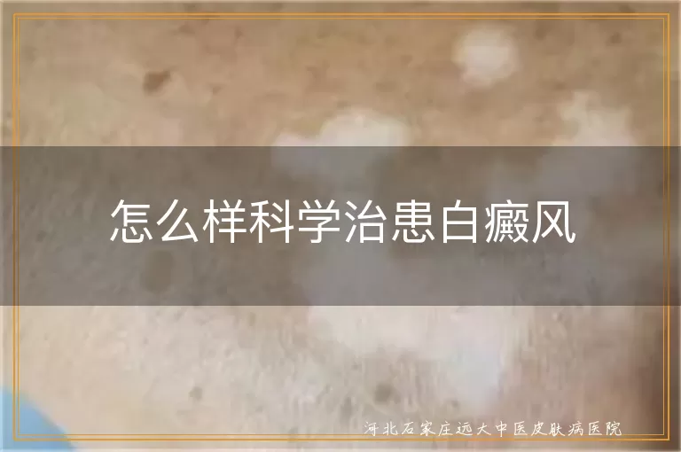 怎么样科学治患白癜风