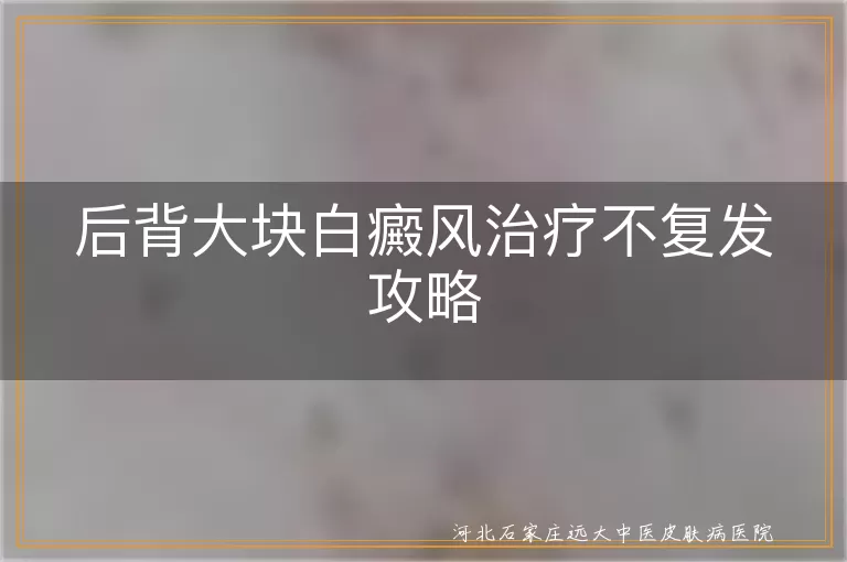 后背大块白癜风治疗不复发攻略
