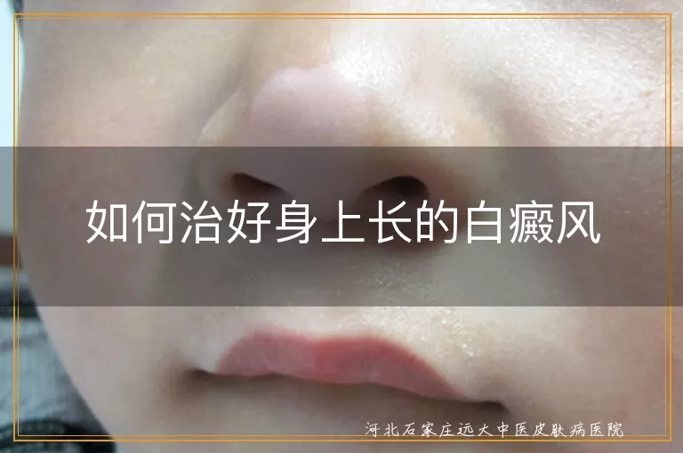 白癜风治疗方法,白斑复色技巧,白癜风日常调理,白癜风光疗效果