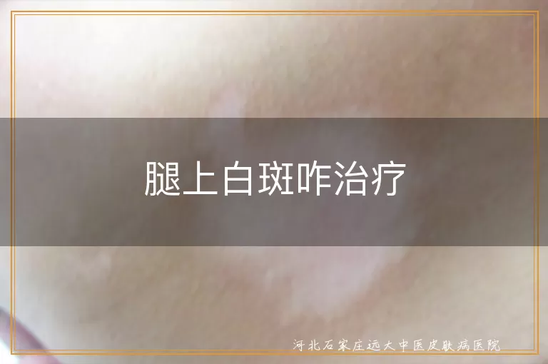腿上白斑咋治疗