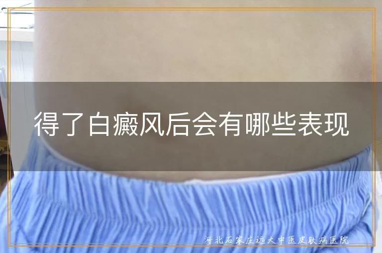 得了白癜风后会有哪些表现