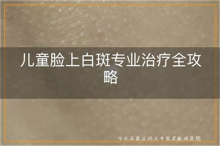 儿童脸上白斑专业治疗全攻略