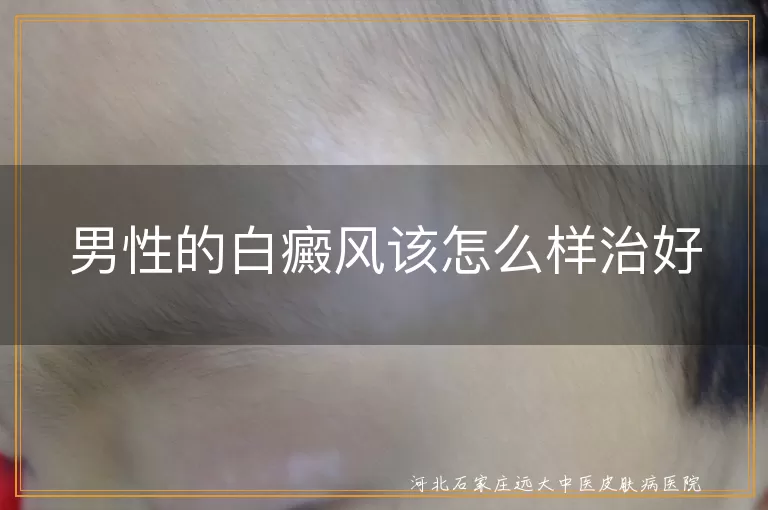 男性的白癜风该怎么样治好