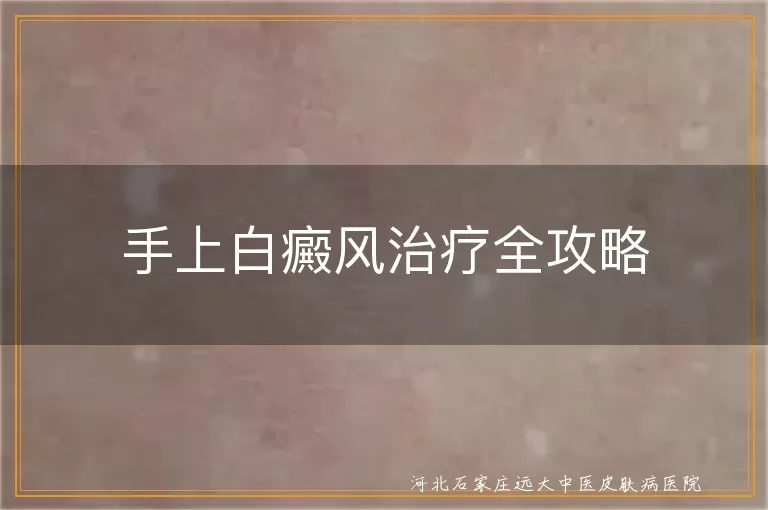 手上白癜风治疗全攻略