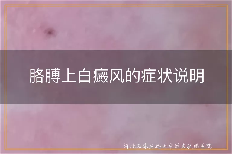 胳膊上白癜风的症状说明