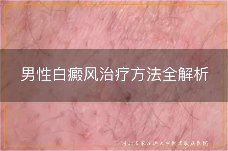 男性白癜风治疗方法全解析