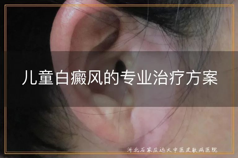 儿童白癜风的专业治疗方案