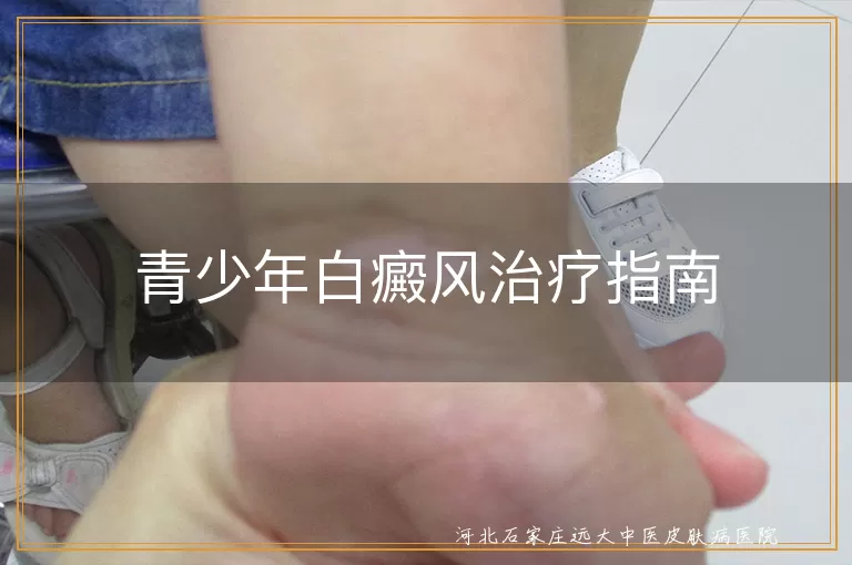 青少年白癜风治疗指南