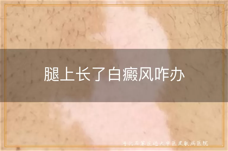 腿上长了白癜风咋办