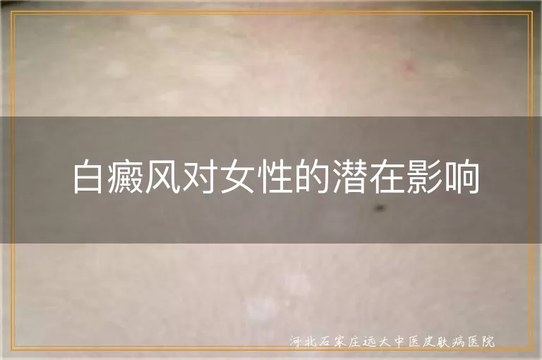 白癜风对女性的潜在影响