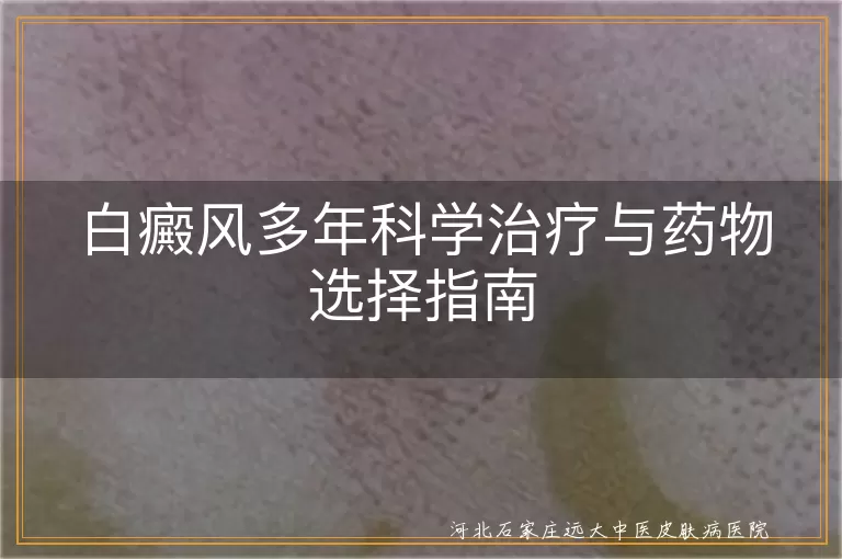 白癜风多年科学治疗与药物选择指南