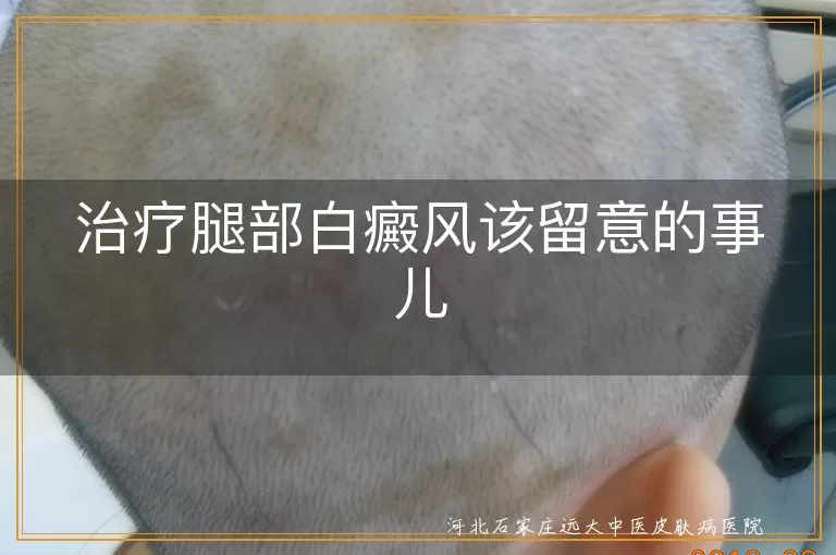 治疗腿部白癜风该留意的事儿