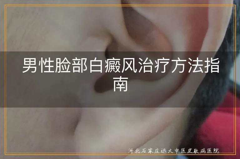 男性脸部白癜风治疗方法指南