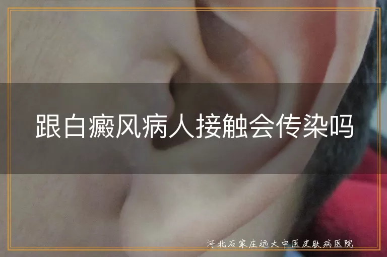 跟白癜风病人接触会传染吗