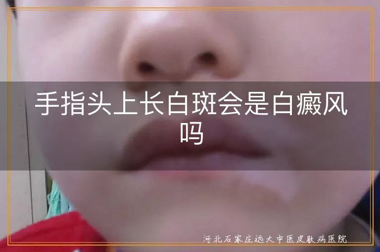 手指头上长白斑会是白癜风吗