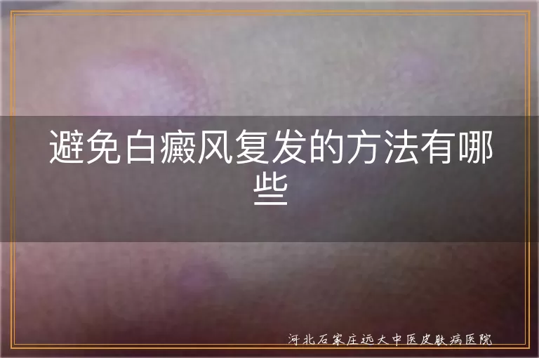 避免白癜风复发的方法有哪些