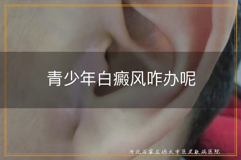 青少年白癜风咋办呢