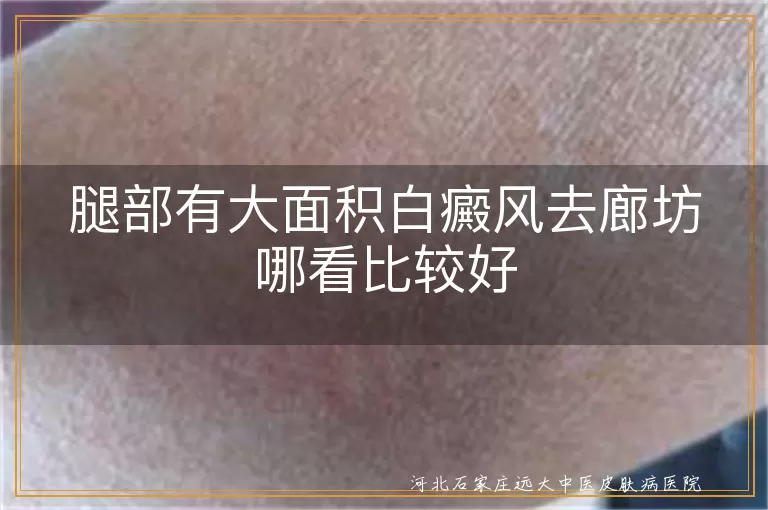腿部有大面积白癜风去廊坊哪看比较好