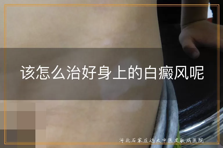 该怎么治好身上的白癜风呢
