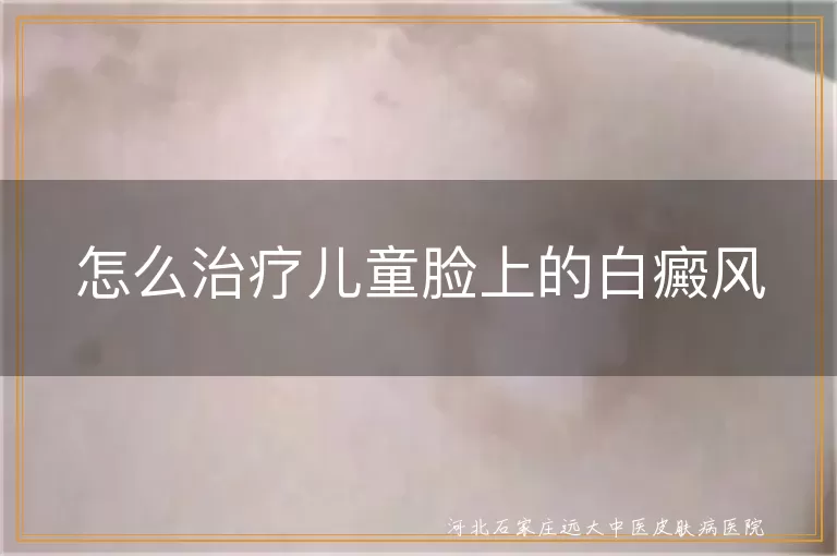怎么治疗儿童脸上的白癜风