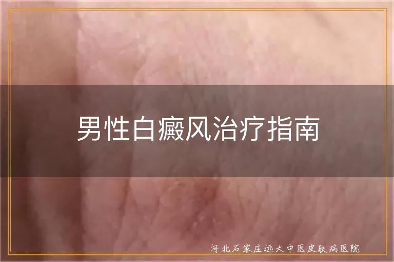 男性白癜风治疗指南