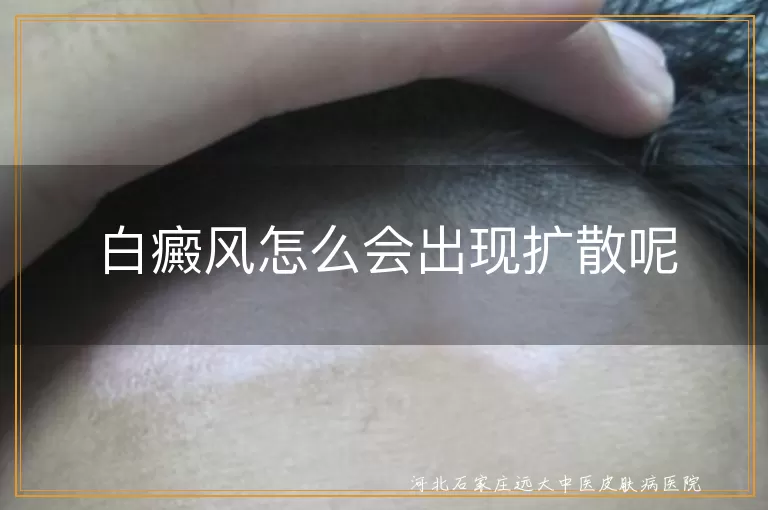 白癜风扩散原因,白斑扩散因素,免疫系统与白癜风,预防白斑扩散