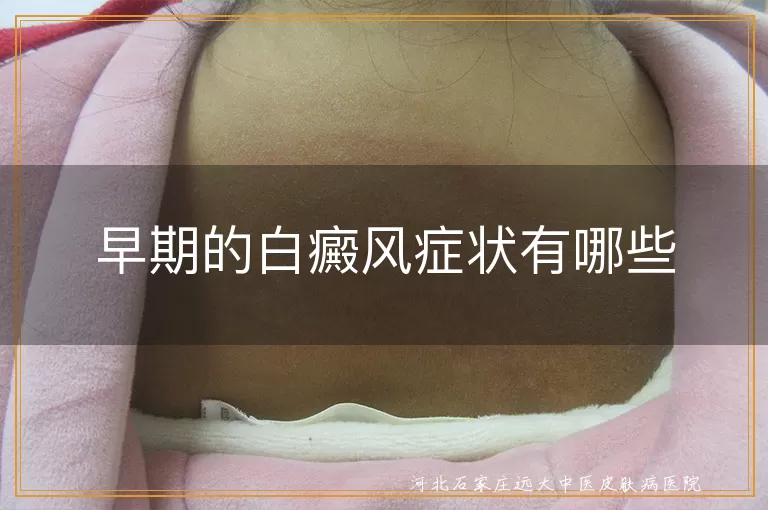 早期的白癜风症状有哪些