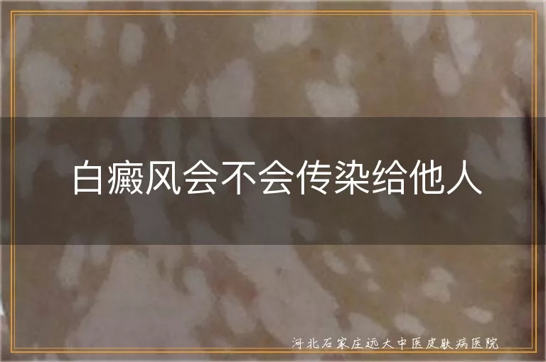 白癜风会不会传染给他人