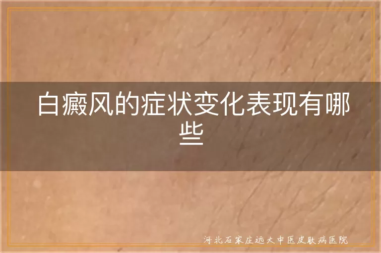白癜风的症状变化表现有哪些