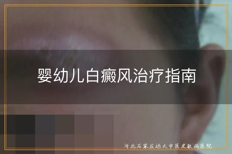 婴幼儿白癜风治疗指南