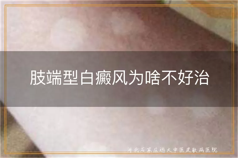 肢端型白癜风为啥不好治