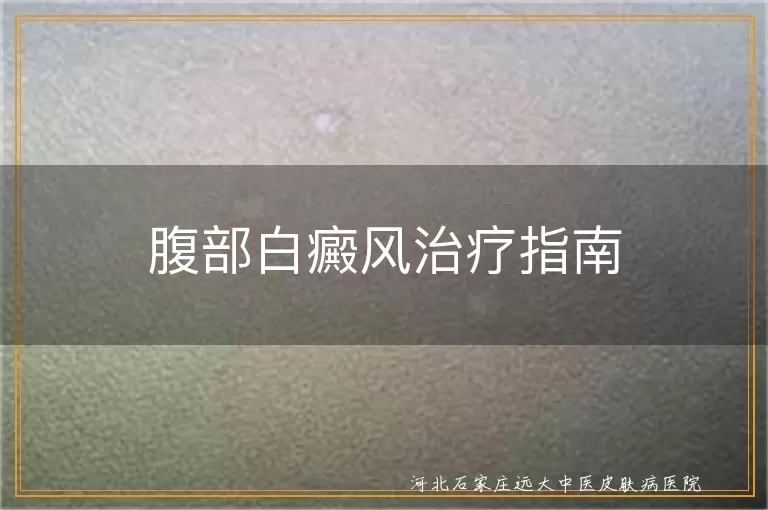 腹部白癜风治疗指南