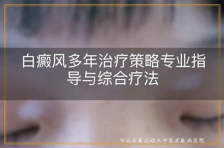 白癜风多年治疗策略专业指导与综合疗法