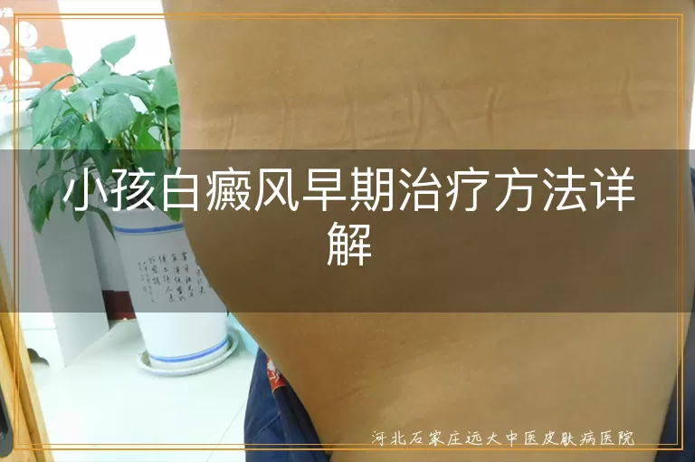 小孩白癜风早期治疗方法详解