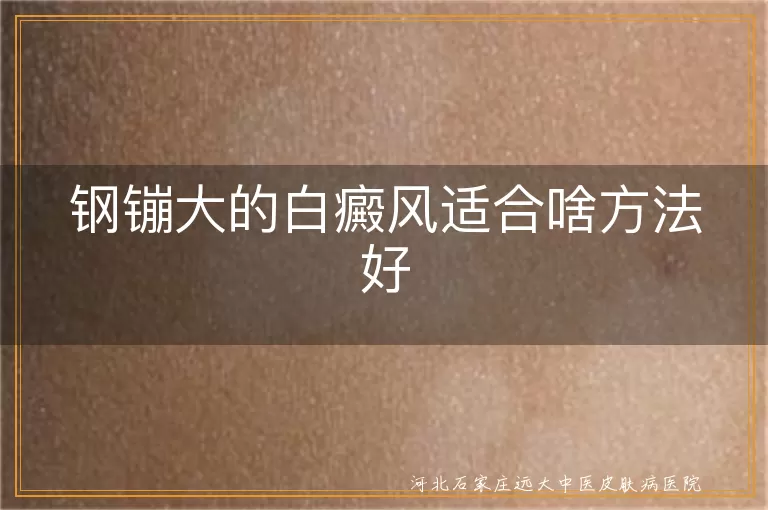 钢镚大的白癜风适合啥方法好