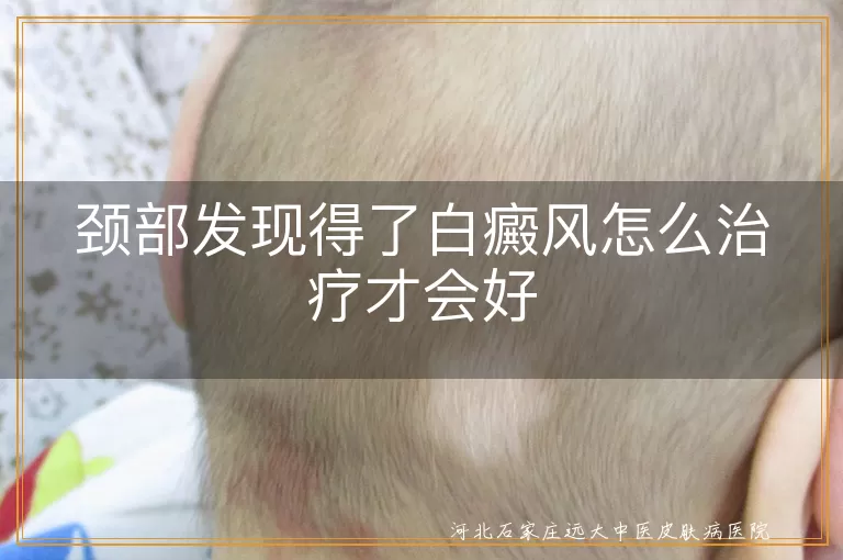 颈部发现得了白癜风怎么治疗才会好