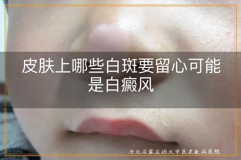皮肤上哪些白斑要留心可能是白癜风