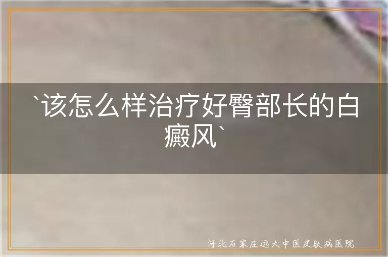 `该怎么样治疗好臀部长的白癜风`