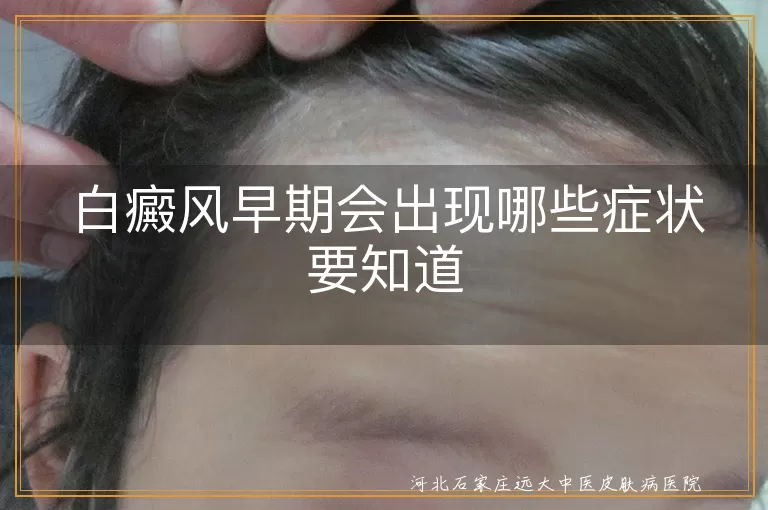白癜风早期会出现哪些症状要知道