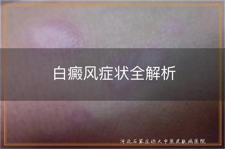 白癜风症状全解析