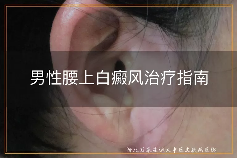 男性腰上白癜风治疗指南