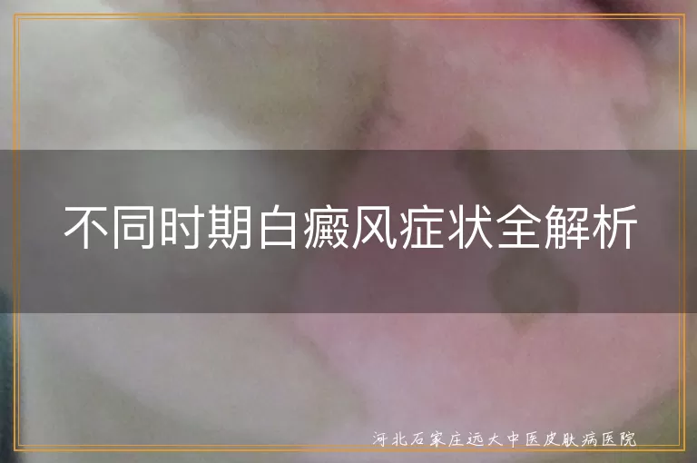 不同时期白癜风症状全解析