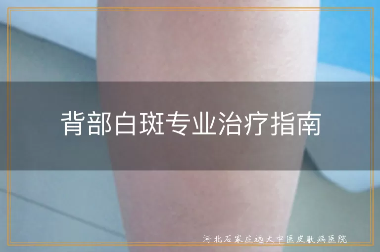 背部白斑专业治疗指南