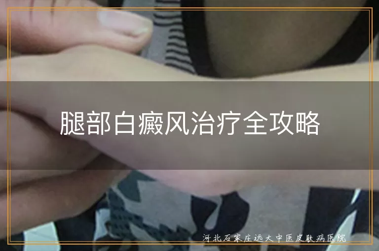腿部白癜风治疗全攻略