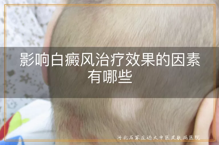 影响白癜风治疗效果的因素有哪些