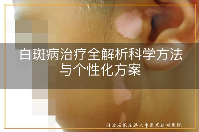 白斑病治疗全解析科学方法与个性化方案